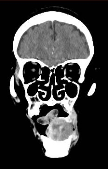 Mặt phẳng trán trên phim CT Scan có cản quang