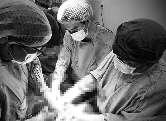Ekip phẫu thuật cấp cứu sản phụ bị tăng Triglycerid máu nặng