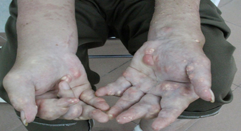 w_benh gout_Untitled-1.jpg