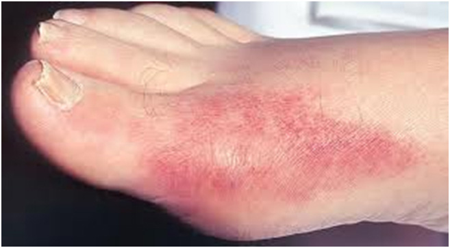 w_benh gout_benh Gout.jpg